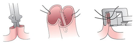 Illustration showing how two parts of the small intestine are connected surgically