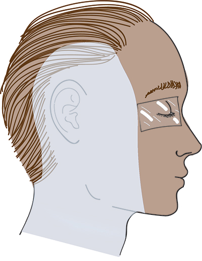 Illustration of the area of the side of the face that should be covered by skin prep for surgery