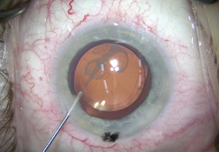 Eye injection
